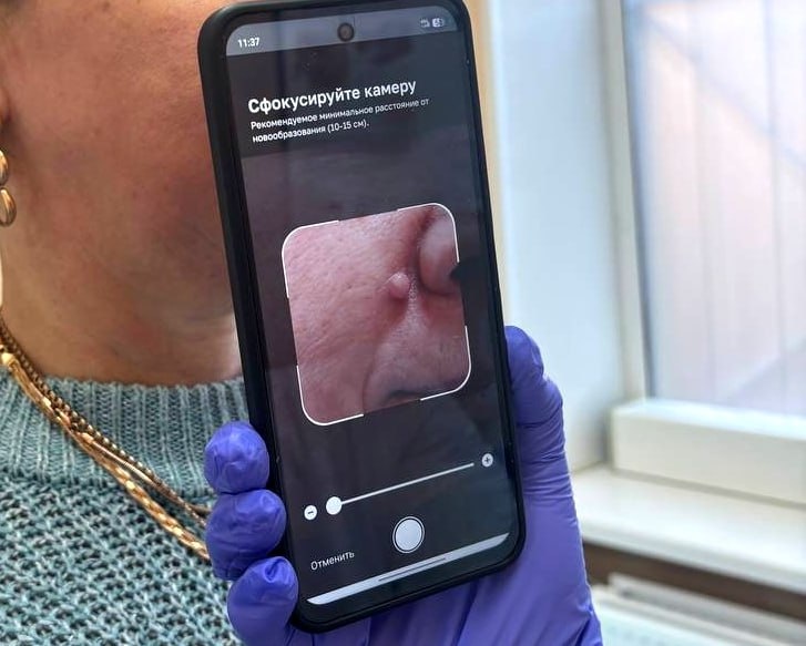 Нижегородцы могут проверить родинки с помощью ИИ в поликлиниках - фото 1