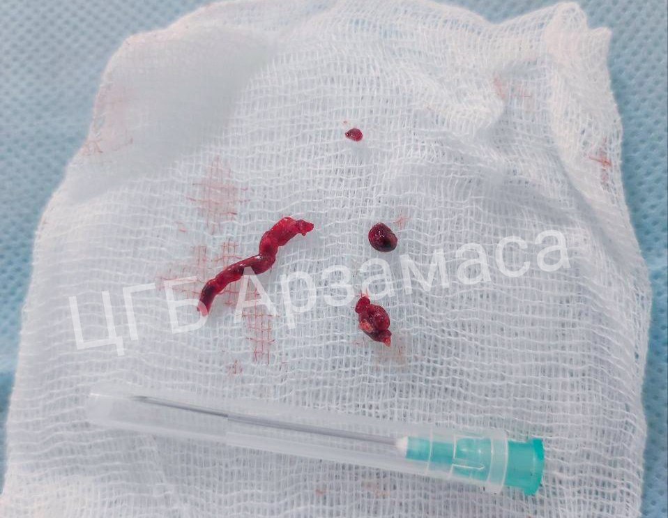 Гигантский тромб удалили из мозга 64-летней нижегородки - фото 1