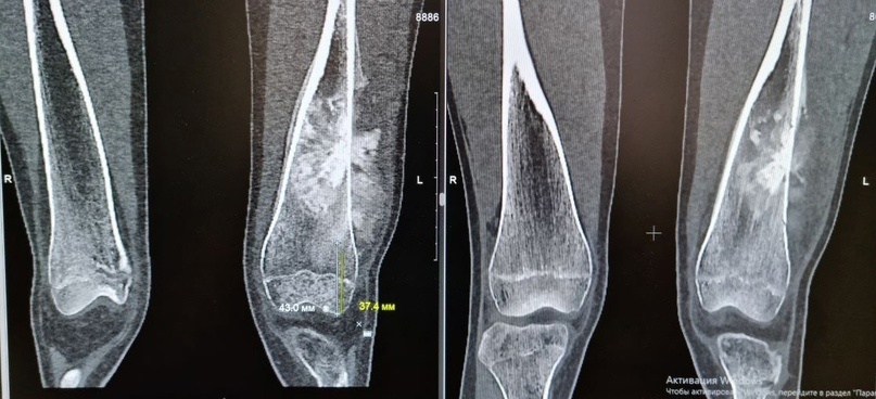 Нижегородке заменили пораженный раком коленный сустав - фото 2